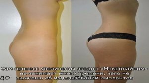 Увеличение ягодиц гиалуроновой кислотой