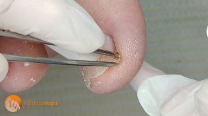 Bye bye nail discomfort! Welcome total cleaning! [Podología Integral]