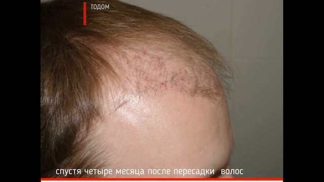 Потеря волос, пересадка волос. Деликатное решение за два дня)