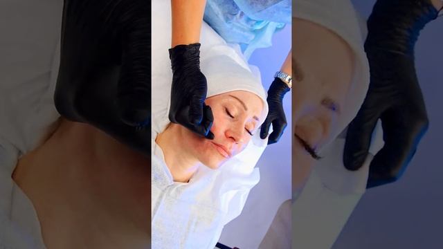 Процедура канюльной реструктуризации реструктуризантом RENOVA REVITAL смотреть онлайн