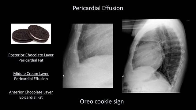 How to Interpret a Chest X-Ray (Lesson 5 - Cardiac Silhouette and Mediastinum) смотреть онлайн