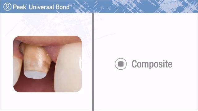 Ultradent’s Versatile Universal Dental Bonding Adhesive смотреть онлайн
