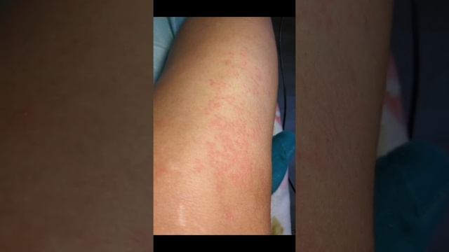Электроэпиляция самой себе. Реакция кожи смотреть онлайн