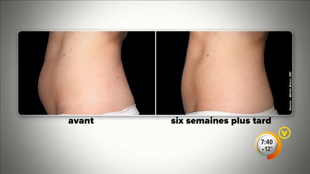 Coolsculpting : Détruire le gras par le froid! Dermapure 27fev2014 V TÉLÉ смотреть онлайн