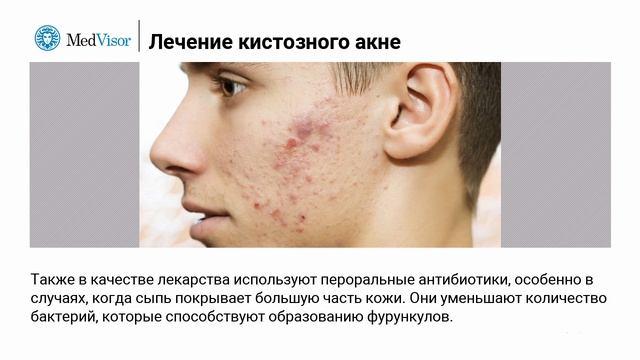 Кистозная форма акне смотреть онлайн