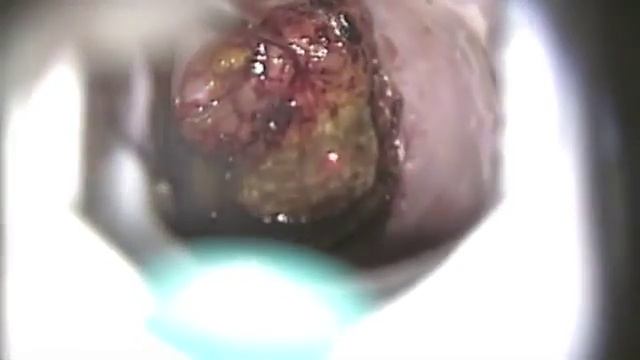 Применение СО2 лазера DEKA в гинекологии смотреть онлайн