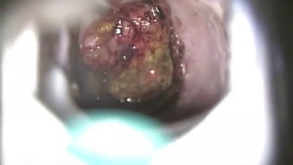 Применение СО2 лазера DEKA в гинекологии