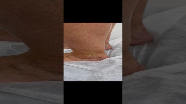 Нетипичная форма варикоза. Флеболог. Сосудистый хирург. Флеболог Москва смотреть онлайн