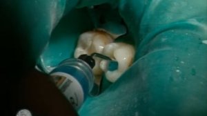 Реставрация зубов по Блэку часть 1