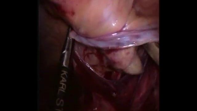 Формирование стомы смотреть онлайн