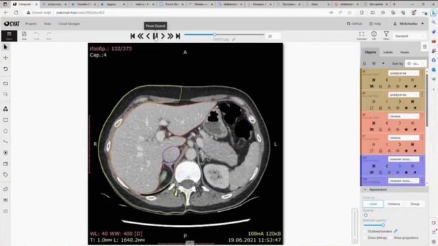 Алгоритимические последовательности при гиповаскулярном метастатическом поражения печени в МСКТ ОБП