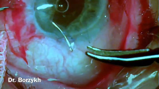 Подшивание ИОЛ смотреть онлайн