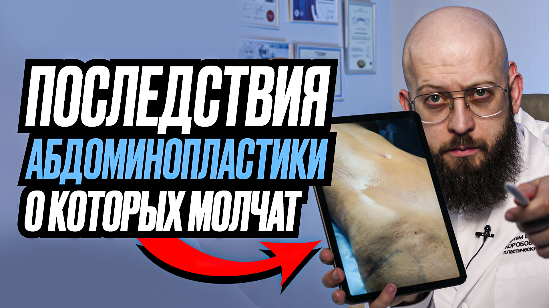 Эти последствия абдоминопластики умалчивают пациенты и хирурги смотреть онлайн