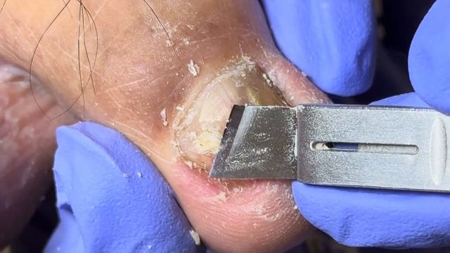 For hard and thick nails, remove them with pliers【Doctor Liu Pedicure】 смотреть онлайн