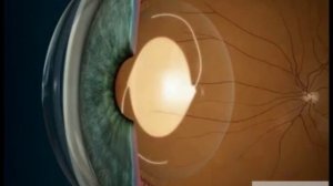 Мультифокальные интраокулярные линзы (ИОЛ) — как они улучшают зрение?