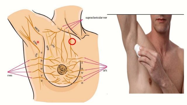Mastectomy nerve damage MRCS question solve (CRACK MRCS) смотреть онлайн