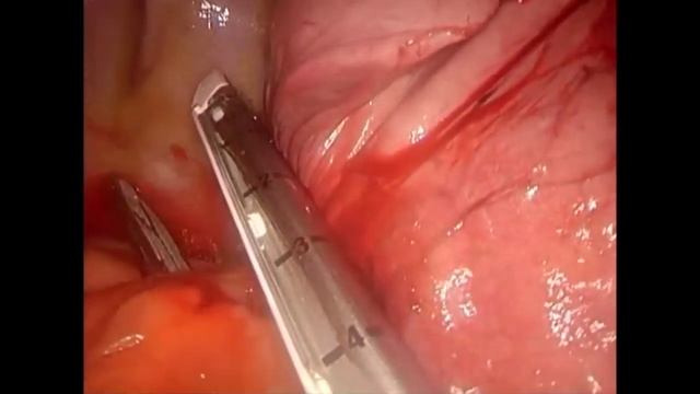 Asvide: This video shows a left lower lobectomy and lymph node dissection in a 77-year-old women... смотреть онлайн
