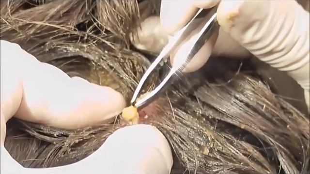 всякие бякушки #10 удаление Овода из головы (личинки мухи) смотреть онлайн