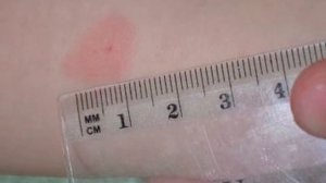 Борьба против туберкулеза.Твое здоровье в твоих руках!