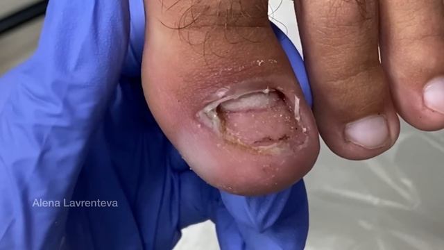 Вырвали ноготь / Ушиб ногтя / Слез ноготь / Подология /