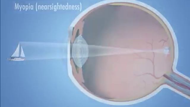 Four Main Types of Refractive Error (vision problems) - Eye Associates смотреть онлайн