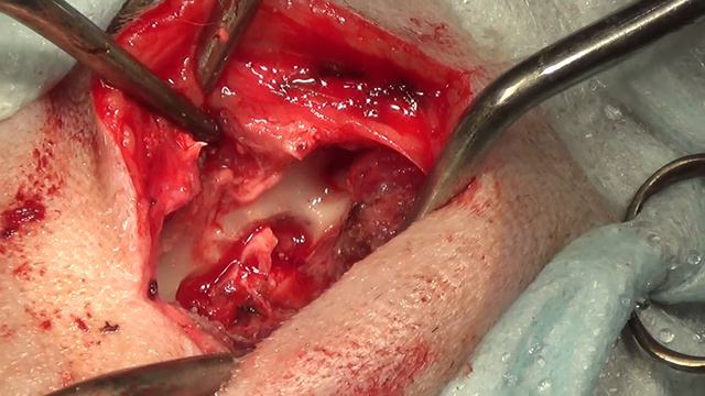 Гемиламинэктомия смотреть онлайн