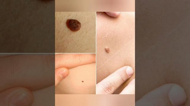 СУПЕР РЕЦЕПТ! Как избавиться от пятен.папиллом и родинок . смотреть онлайн