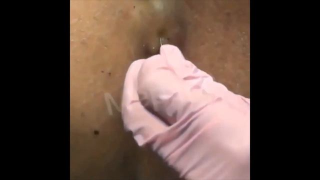 №1Давят прыщи смотреть онлайн