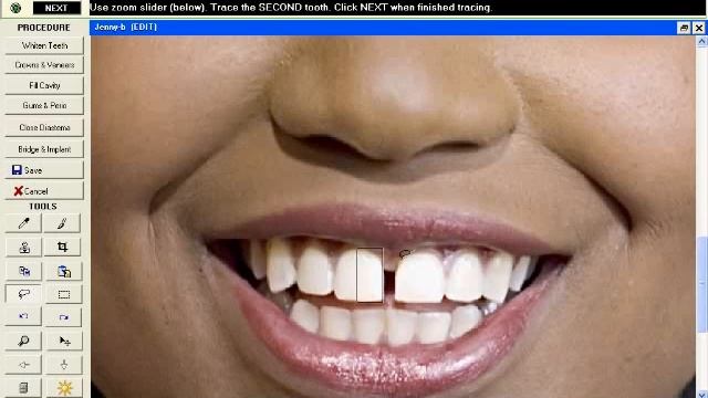 Close Diastema/Spaces with SNAP Dental Cosmetic Simulation Software смотреть онлайн