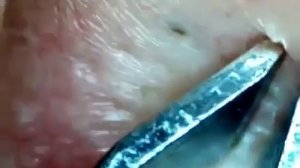 Удаление комедона ушной раковины |  Большой комедон в ухе