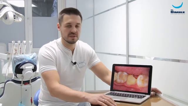 Коронка и имплантация зуба  Капранов М. Ю. (Клиника Dr Smile)