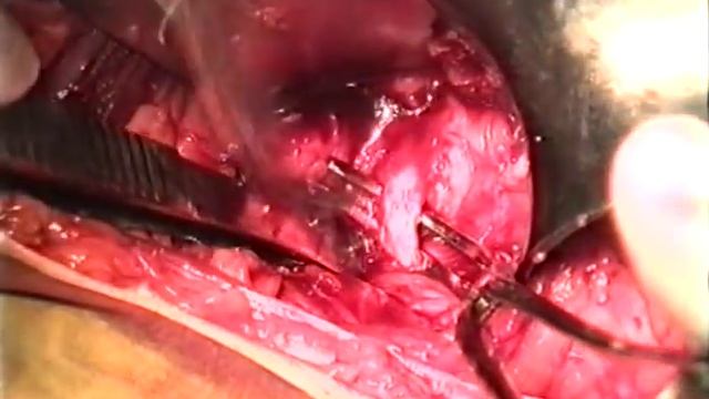 Экстраперитонеальный доступ при перевязке подвздошной артерии ©Ligation of the internal iliac arter смотреть онлайн