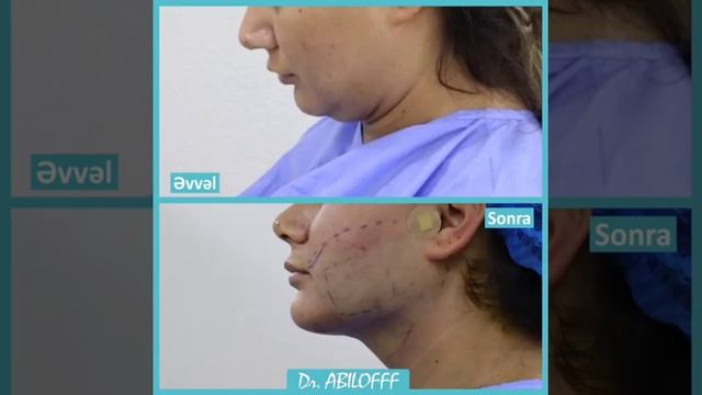 Dr. Sabuhi ABİLOV - Buxağın EndoLazer Liporeduksiyası - Estetik Cərrah