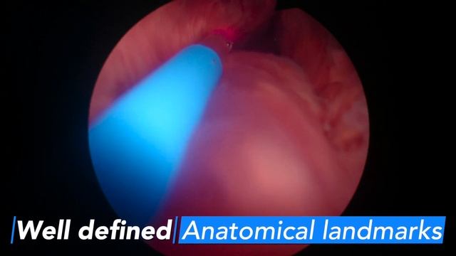 Lazarus 3D hyper realistic Holmium Laser Prostate Enucleation смотреть онлайн