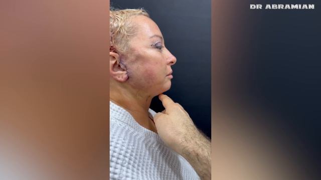 Омоложение лица: Лариса из Израиля смотреть онлайн