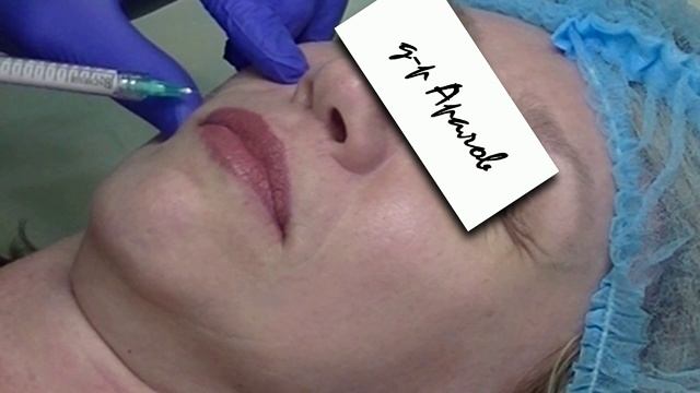 Коррекция носогубных складок. Correction of nasolabial folds. смотреть онлайн