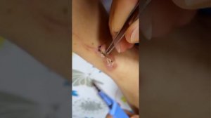 Снятие хирургических швов дома