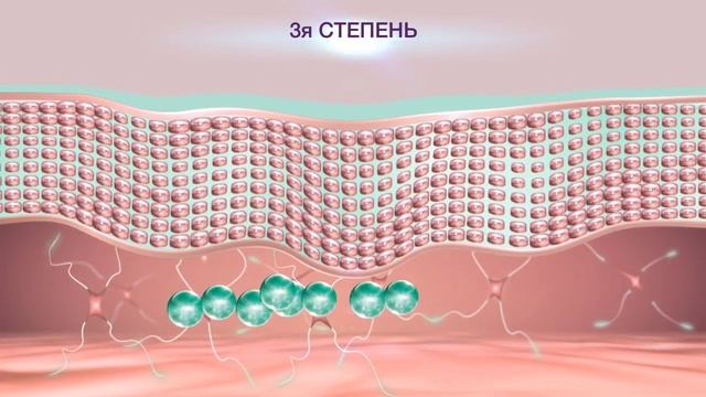 Hyalurides LP - 4 формы гиалуроновой кислоты для 4х действий против морщин ! смотреть онлайн