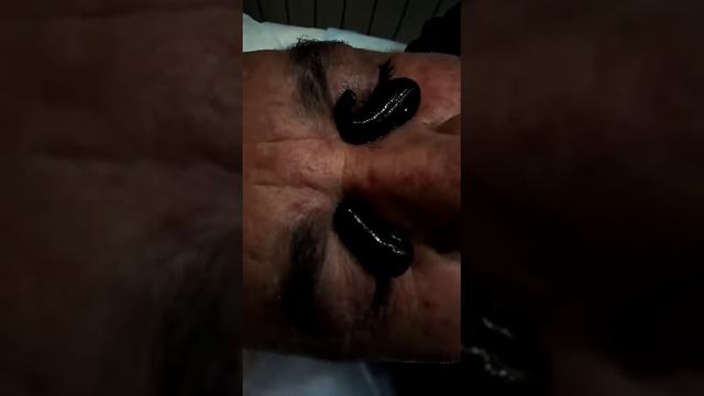 Хиджама лица. Гирудотерапия.