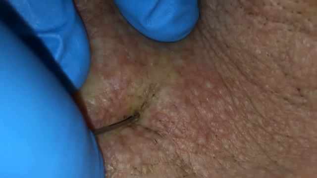 Blackheads POP! | Auburn Medical Group смотреть онлайн