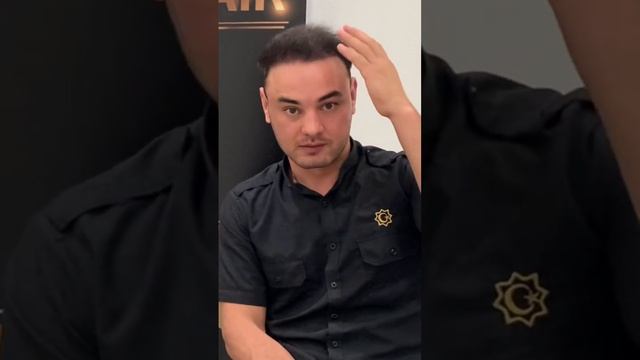 Пересадка волос в Москве #пересадкаволос #пересадкабровей