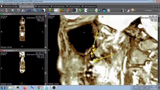 ЗУБЫ НА МРТ . смотреть онлайн