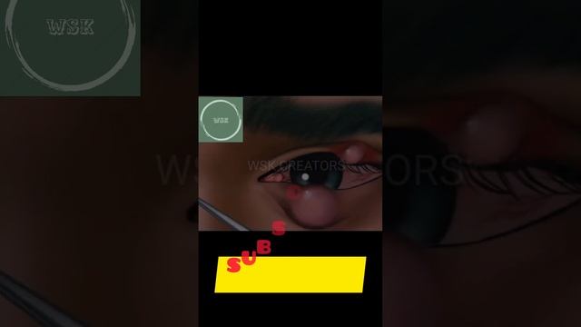 Eyes infection treatment | eye treatment #asmr #shorts смотреть онлайн