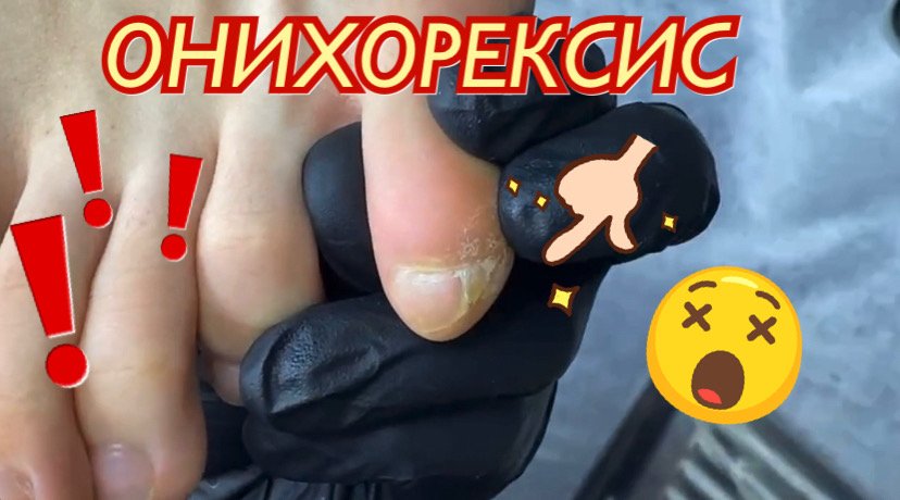 ОНИХОРЕКСИС ?⚠️??? смотреть онлайн