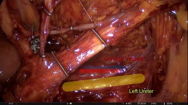 Preservation of Left Colic Artery after Lymph Node Dissection of IMA root смотреть онлайн