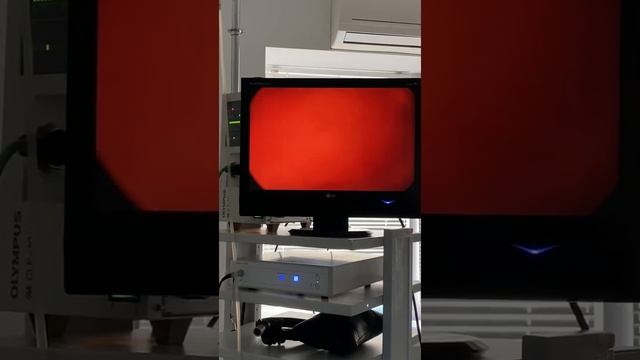 Гистерорезектоскопия. Удаление полипа смотреть онлайн