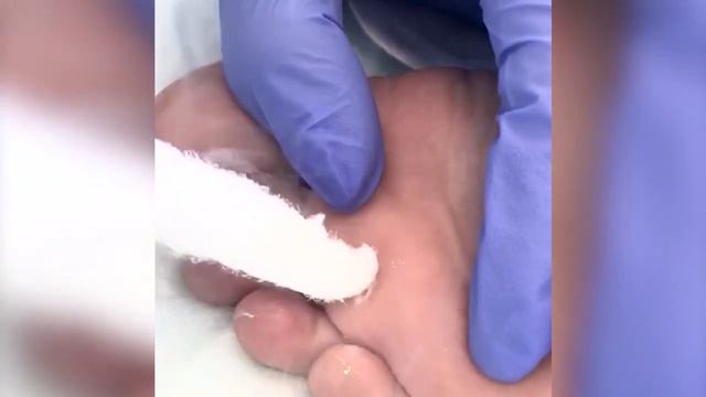 Удаление бородавки жидким азотом в "БЕТТА КЛИНИКА" смотреть онлайн