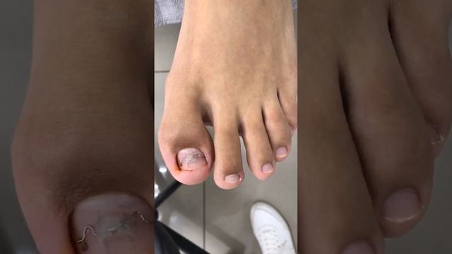 Установка титановой нити - Подолог