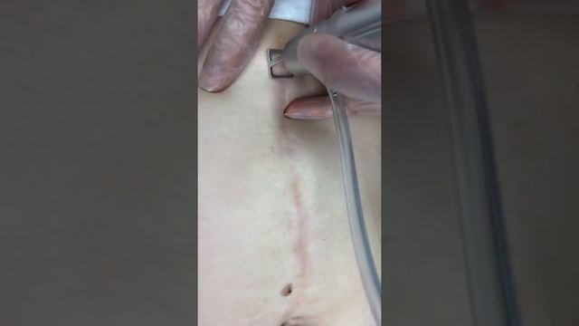 Лазерное удаление рубца смотреть онлайн