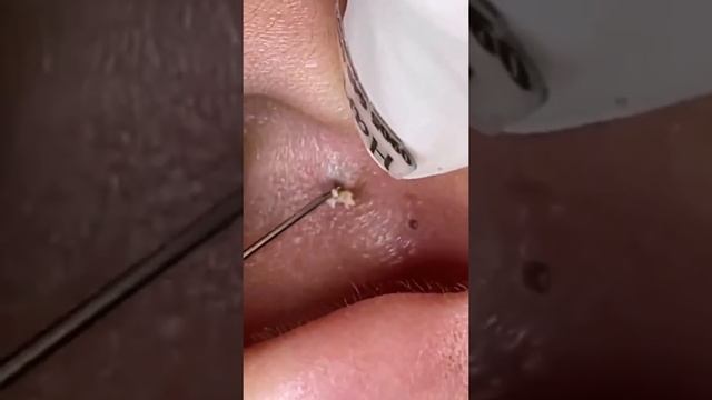 Popping Huge Blackheads And Pimple Popping - Best Pimple Popping Videos #2